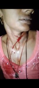 पत्नी के गले पर प्रहार कर पति ने किया लहूलुहान